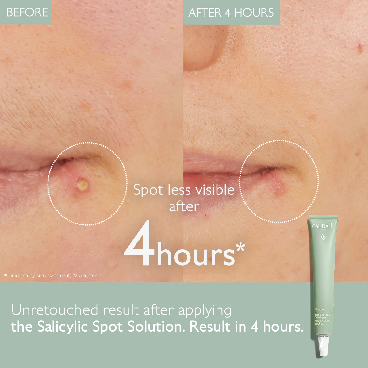 Vinopure Salicylic Spot Solution 15ml - Image 3