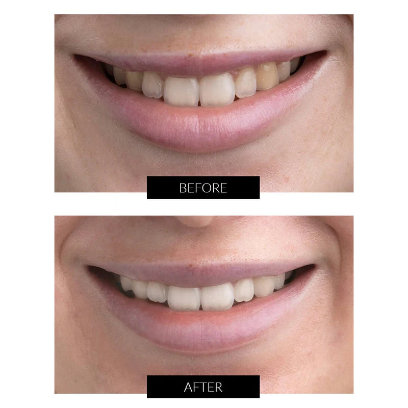 Teeth Whitening Gel Refill Syringes 3x5ml units - Image 2