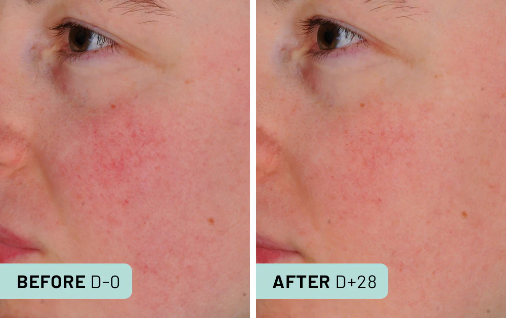 Redness Relief Serum 4 Capsules / 1 month - Image 4